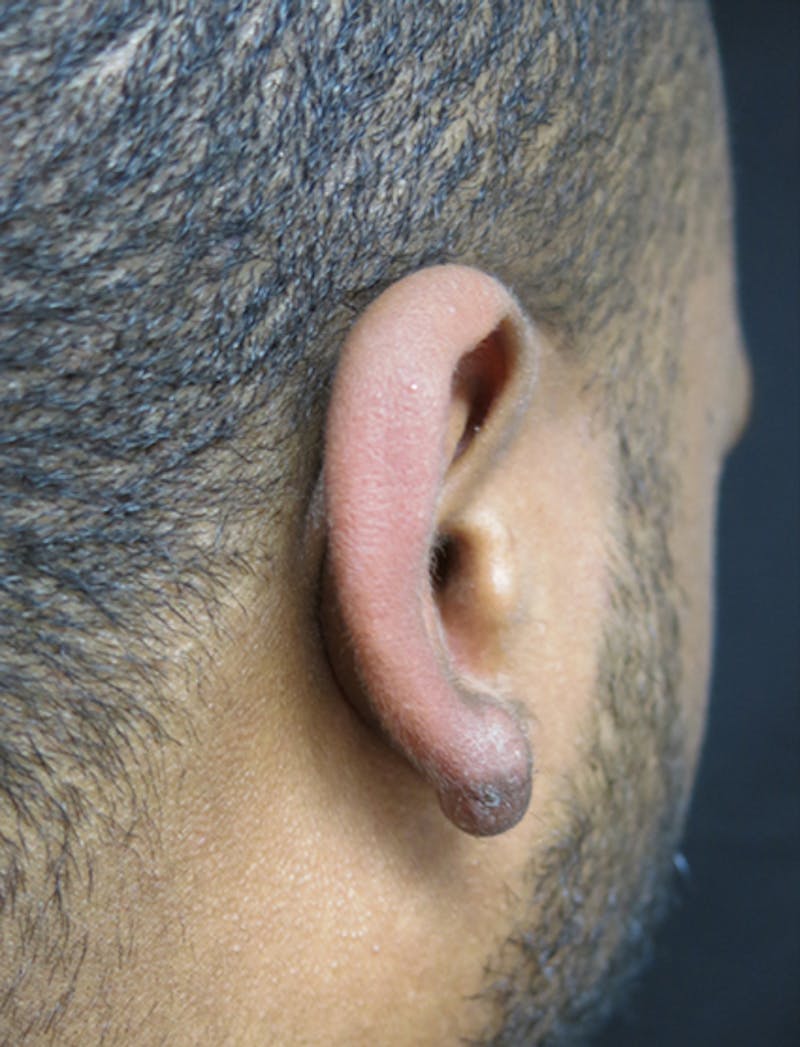 Ear Lobe Repair and Ear Reconstruction Before & After Gallery - Patient 122909079 - Image 8