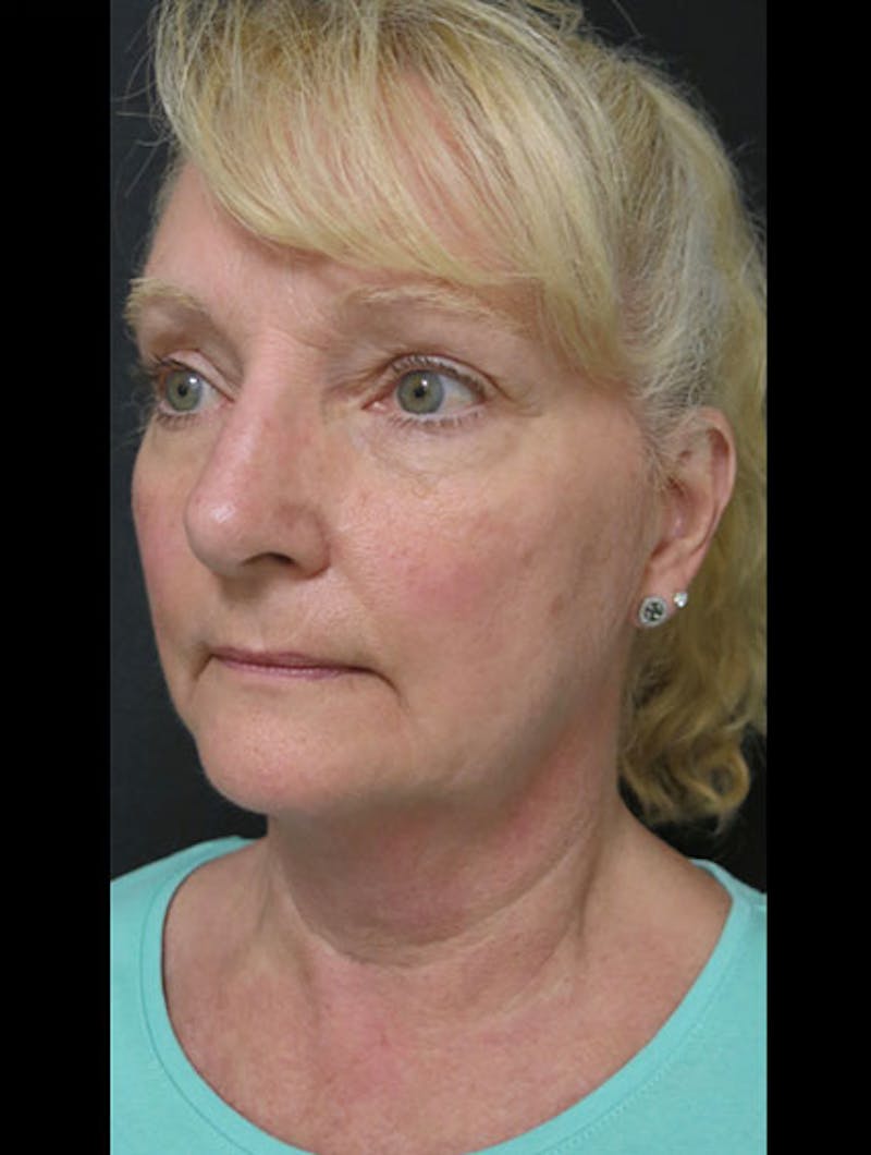 Facial Fat Grafting Before & After Gallery - Patient 122909087 - Image 7