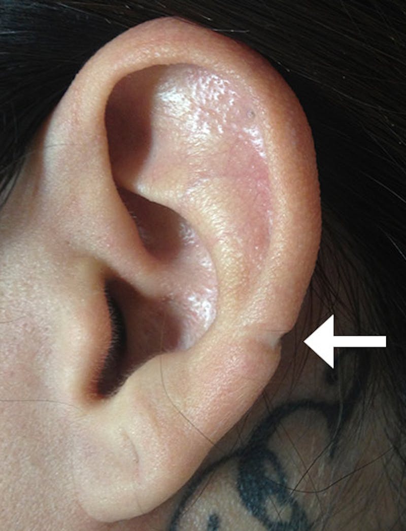 Ear Lobe Repair and Ear Reconstruction Before & After Gallery - Patient 122909081 - Image 1