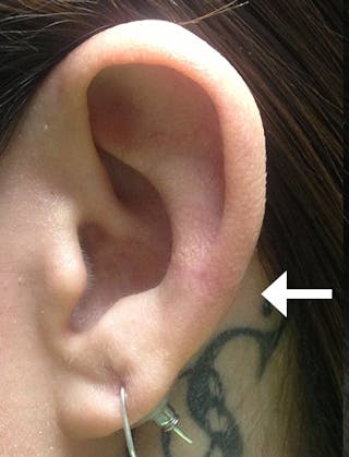 Ear Lobe Repair and Ear Reconstruction Before & After Gallery - Patient 122909081 - Image 2