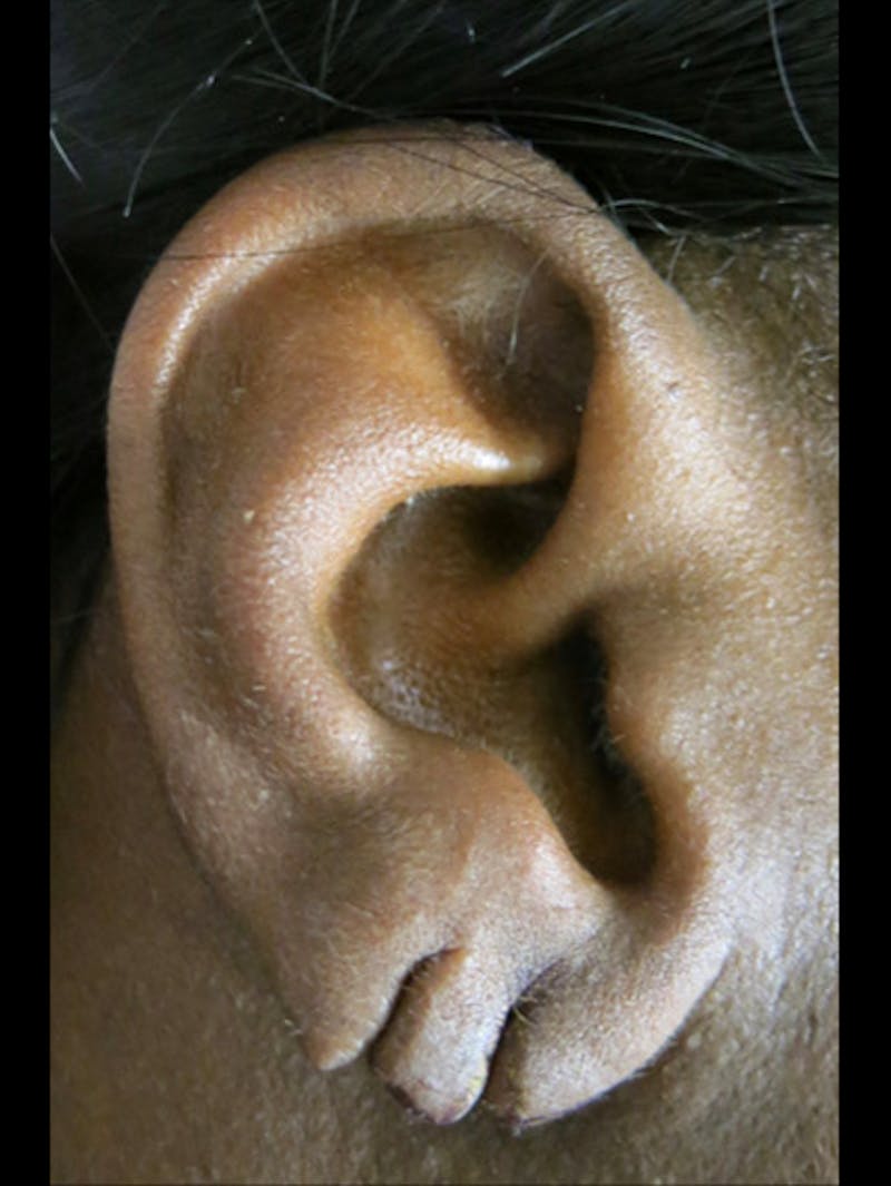 Ear Lobe Repair and Ear Reconstruction Before & After Gallery - Patient 122909082 - Image 1