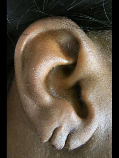 Ear Lobe Repair and Ear Reconstruction Before & After Gallery - Patient 122909082 - Image 1