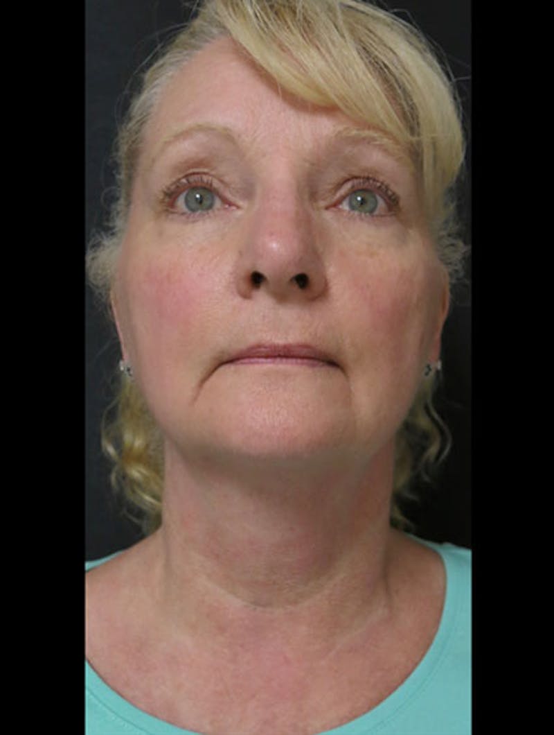 Facial Fat Grafting Before & After Gallery - Patient 122909087 - Image 11