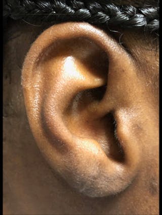 Ear Lobe Repair and Ear Reconstruction Before & After Gallery - Patient 122909082 - Image 2