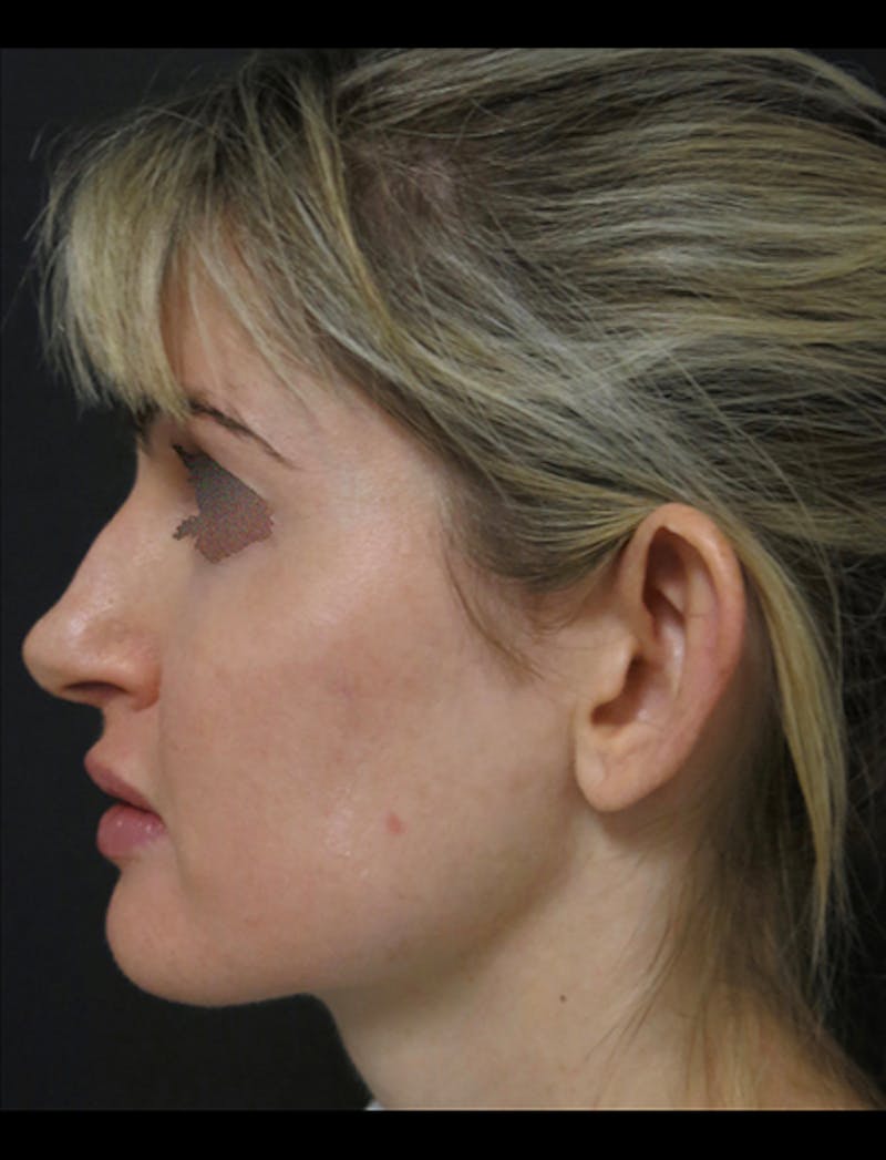 Otoplasty Ear Pinning Before & After Gallery - Patient 122909092 - Image 3