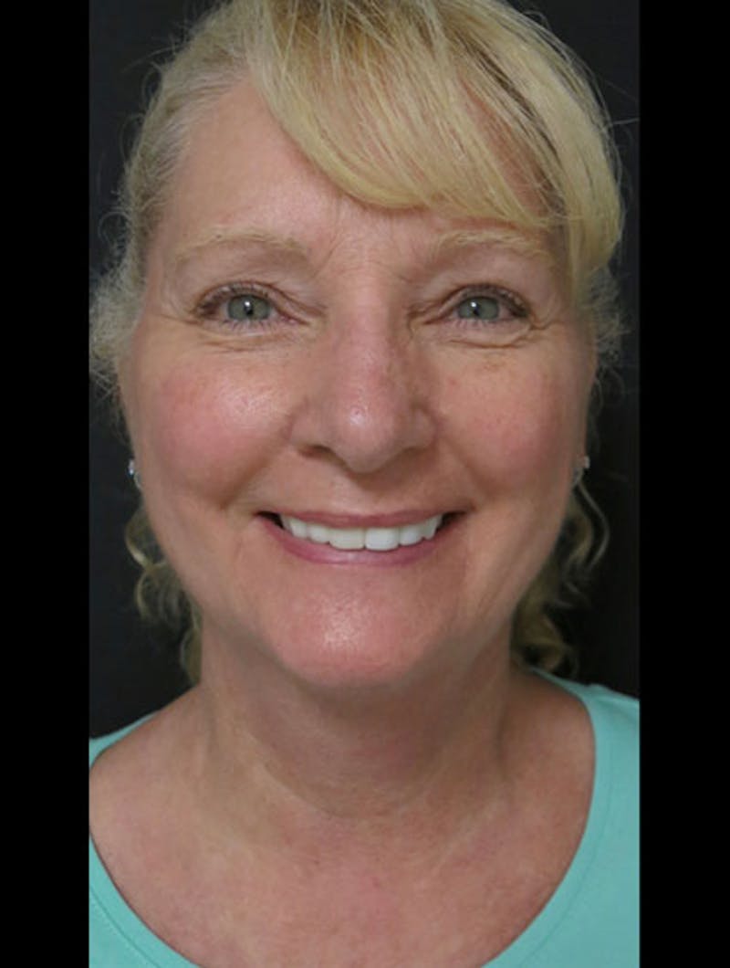 Facial Fat Grafting Before & After Gallery - Patient 122909087 - Image 13