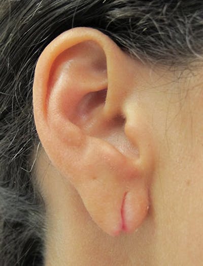 Ear Lobe Repair and Ear Reconstruction Before & After Gallery - Patient 122909088 - Image 1