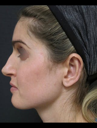 Otoplasty Ear Pinning Before & After Gallery - Patient 122909092 - Image 4