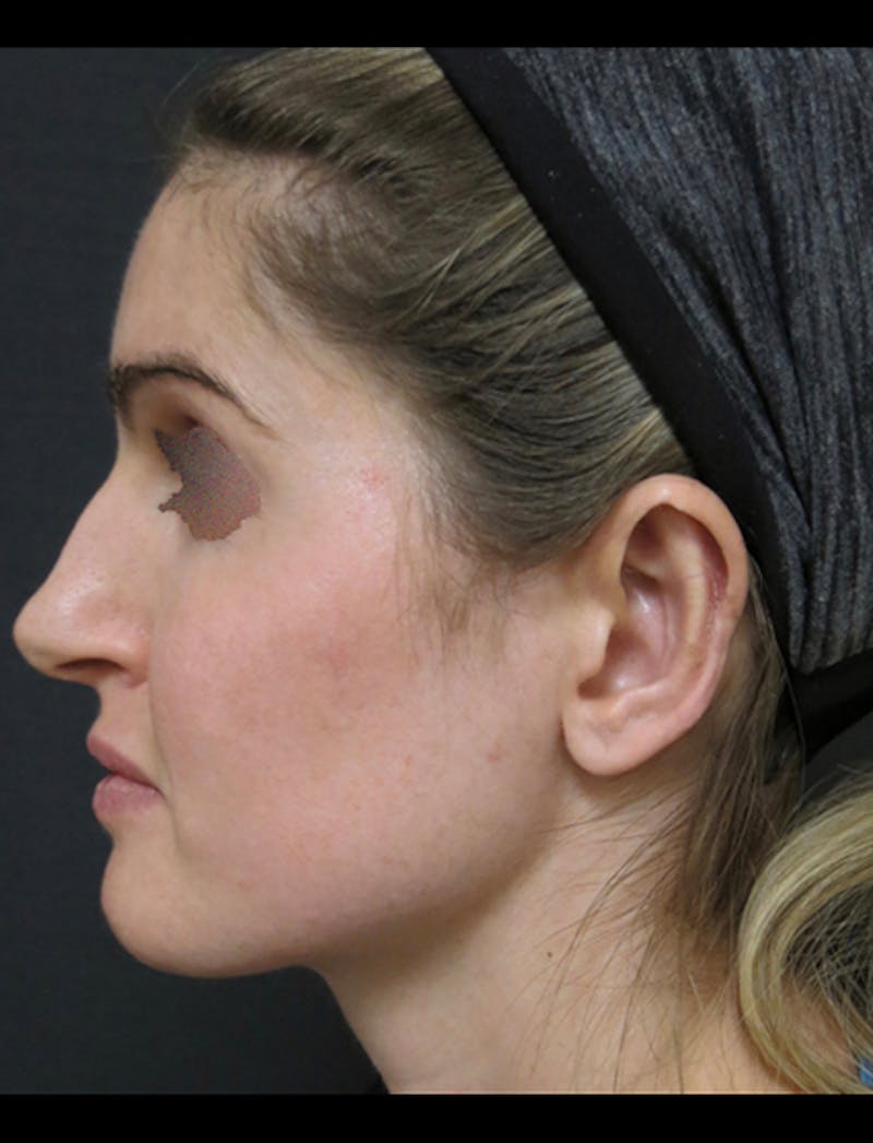 Otoplasty Ear Pinning Before & After Gallery - Patient 122909092 - Image 4