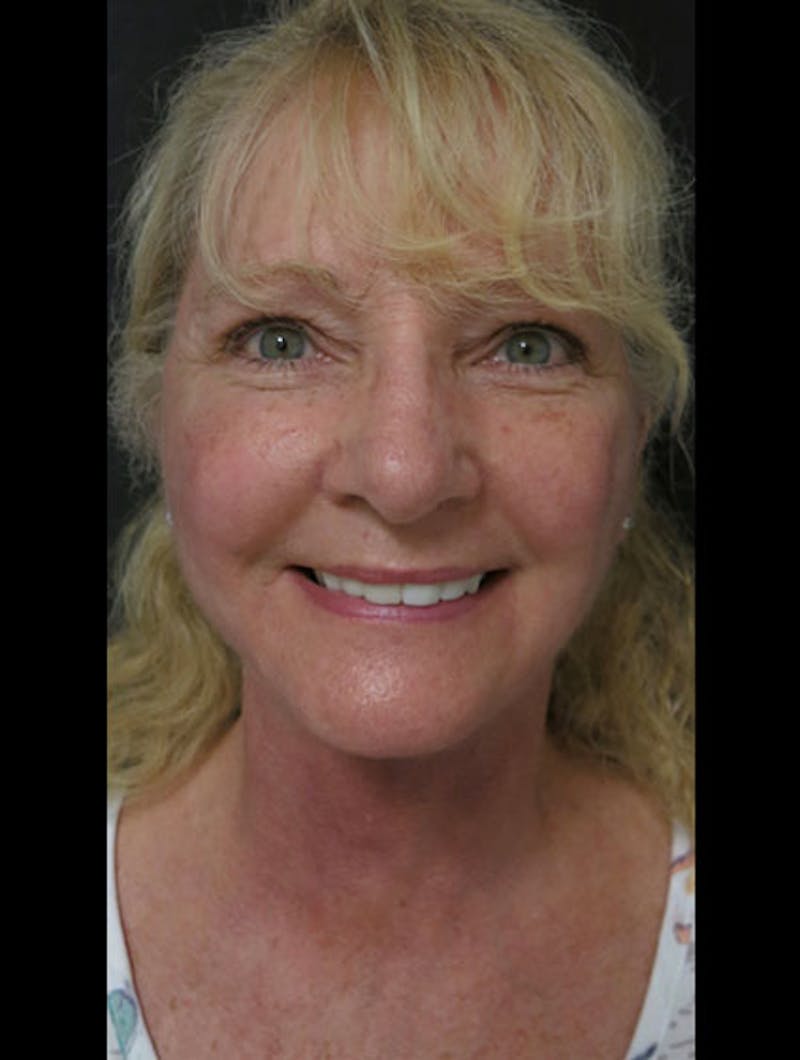 Facial Fat Grafting Before & After Gallery - Patient 122909087 - Image 14
