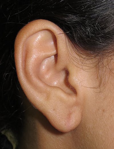 Ear Lobe Repair and Ear Reconstruction Before & After Gallery - Patient 122909088 - Image 2