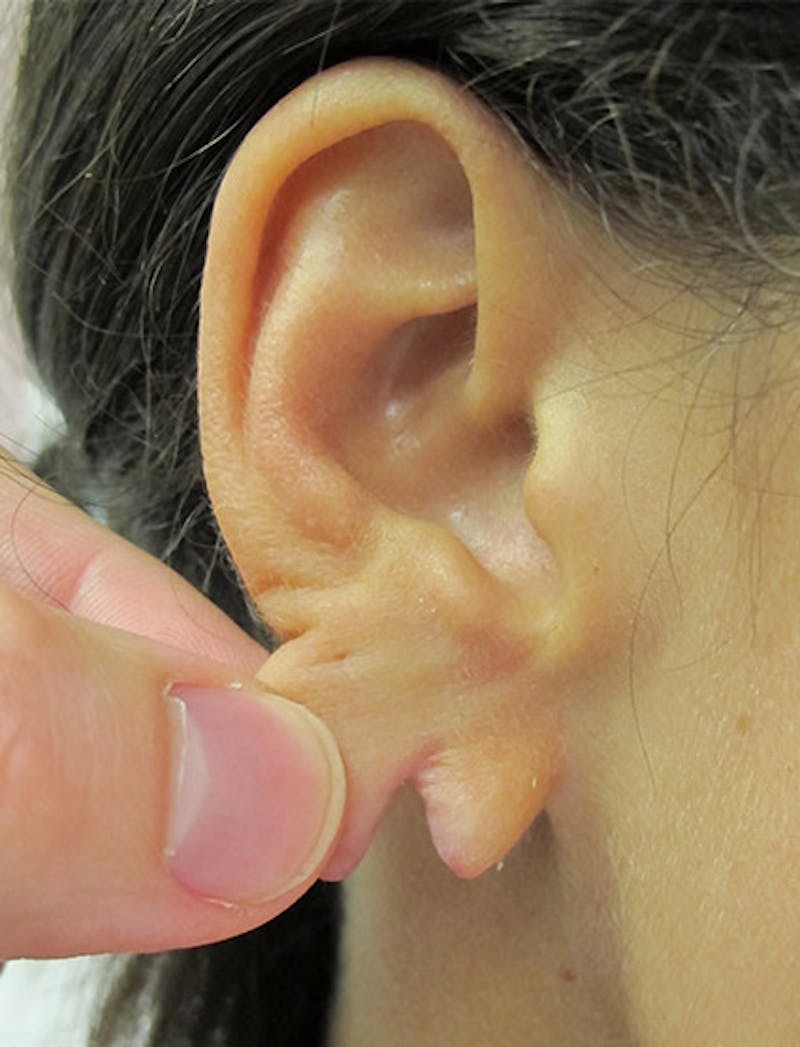 Ear Lobe Repair and Ear Reconstruction Before & After Gallery - Patient 122909088 - Image 3