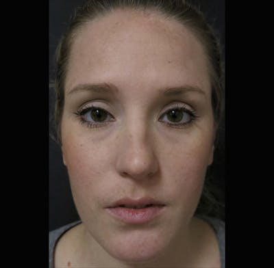 Facial Fat Grafting Before & After Gallery - Patient 122909091 - Image 1
