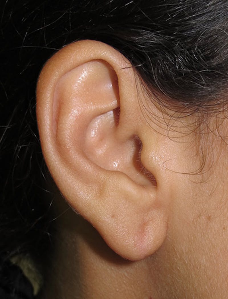 Ear Lobe Repair and Ear Reconstruction Before & After Gallery - Patient 122909088 - Image 4