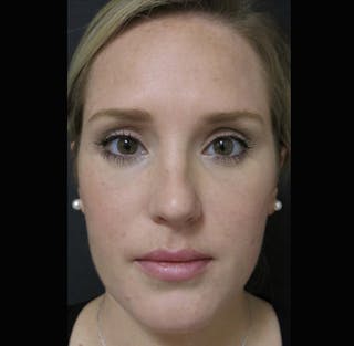 Facial Fat Grafting Before & After Gallery - Patient 122909091 - Image 2