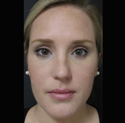 Facial Fat Grafting Before & After Gallery - Patient 122909091 - Image 2
