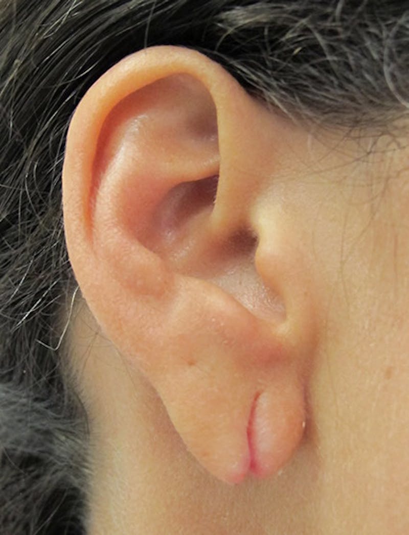 Ear Lobe Repair and Ear Reconstruction Before & After Gallery - Patient 122909088 - Image 5