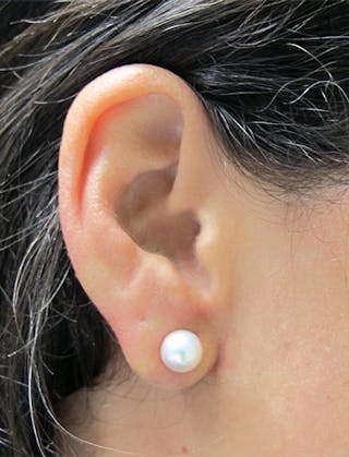 Ear Lobe Repair and Ear Reconstruction Before & After Gallery - Patient 122909088 - Image 6
