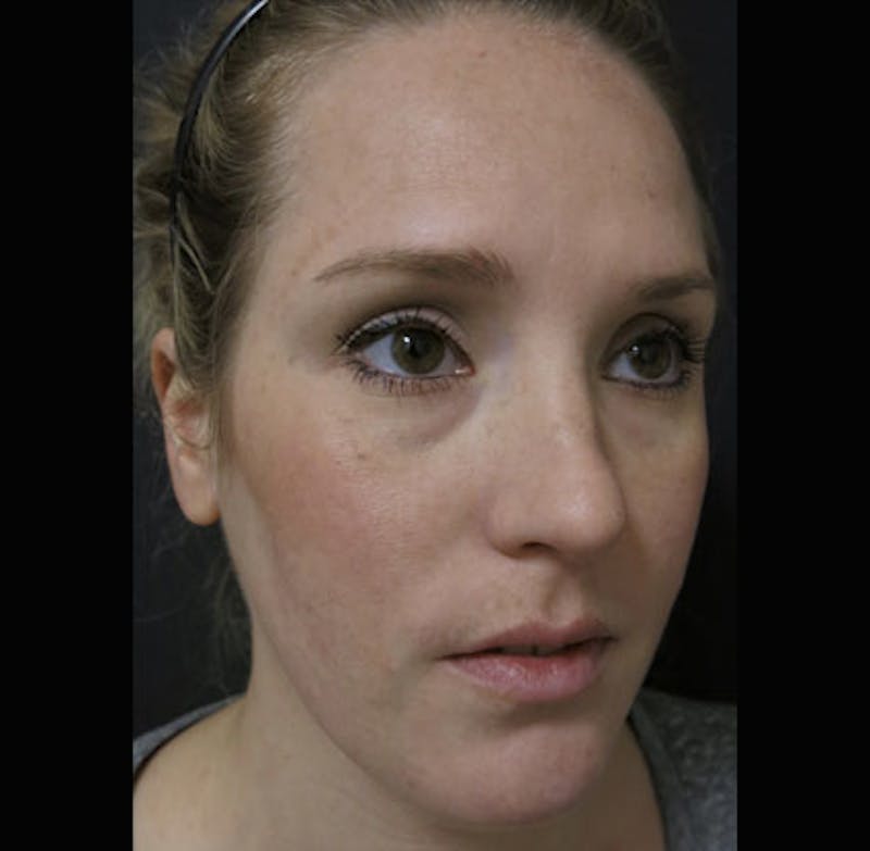 Facial Fat Grafting Before & After Gallery - Patient 122909091 - Image 5
