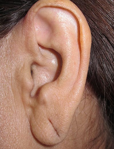 Ear Lobe Repair and Ear Reconstruction Before & After Gallery - Patient 122909090 - Image 1