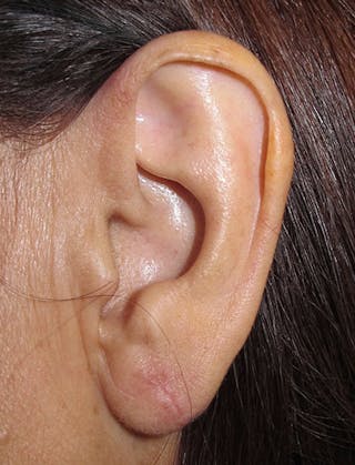 Ear Lobe Repair and Ear Reconstruction Before & After Gallery - Patient 122909090 - Image 2