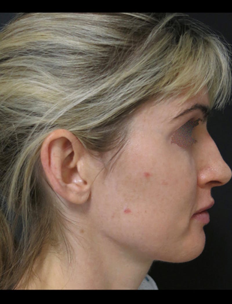 Otoplasty Ear Pinning Before & After Gallery - Patient 122909092 - Image 11