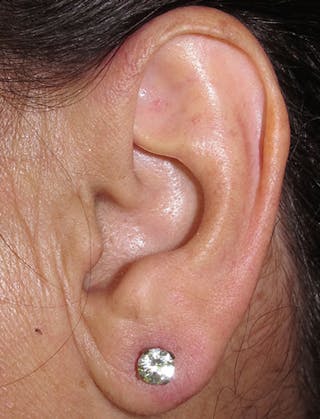 Ear Lobe Repair and Ear Reconstruction Before & After Gallery - Patient 122909090 - Image 4