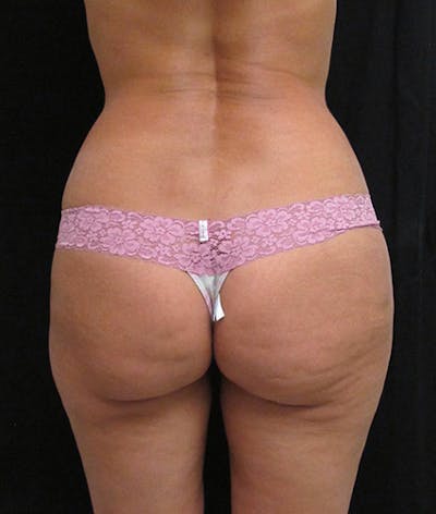 Brazilian Butt Lift Before & After Gallery - Patient 122909093 - Image 1