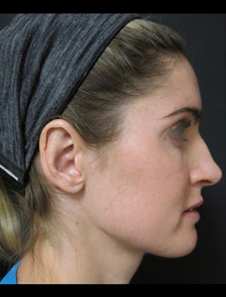 Otoplasty Ear Pinning Before & After Gallery - Patient 122909092 - Image 12