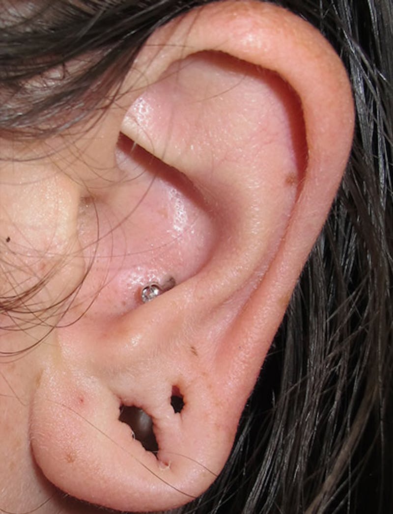 Ear Lobe Repair and Ear Reconstruction Before & After Gallery - Patient 122909094 - Image 1
