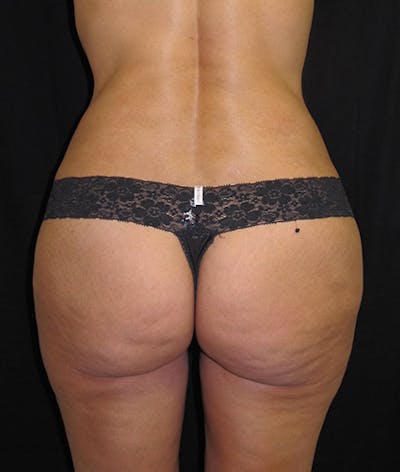 Brazilian Butt Lift Before & After Gallery - Patient 122909093 - Image 2