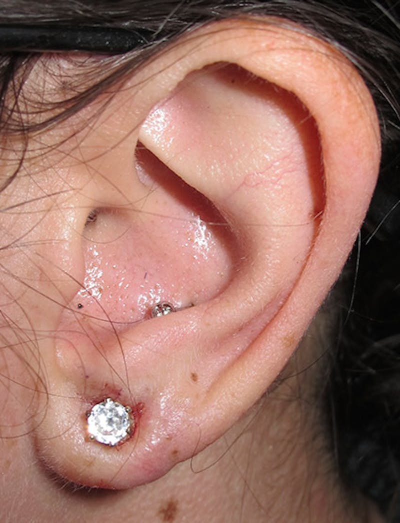 Ear Lobe Repair and Ear Reconstruction Before & After Gallery - Patient 122909094 - Image 2