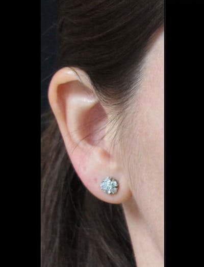 Otoplasty Ear Pinning Before & After Gallery - Patient 122909095 - Image 1