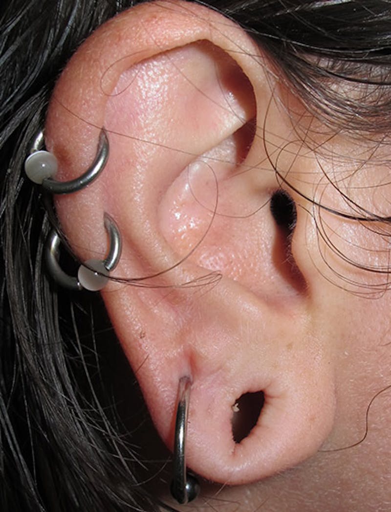 Ear Lobe Repair and Ear Reconstruction Before & After Gallery - Patient 122909094 - Image 3