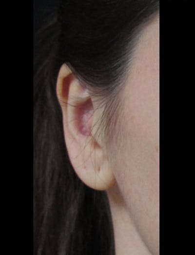 Otoplasty Ear Pinning Before & After Gallery - Patient 122909095 - Image 2