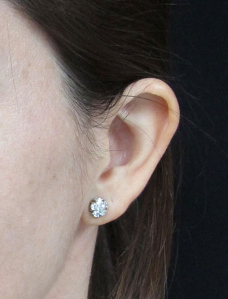 Otoplasty Ear Pinning Before & After Gallery - Patient 122909095 - Image 3