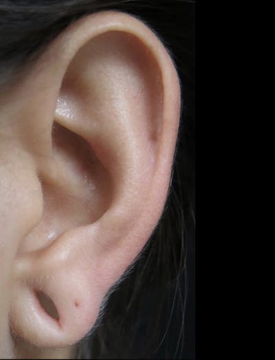 Ear Lobe Repair and Ear Reconstruction Before & After Gallery - Patient 122909098 - Image 1