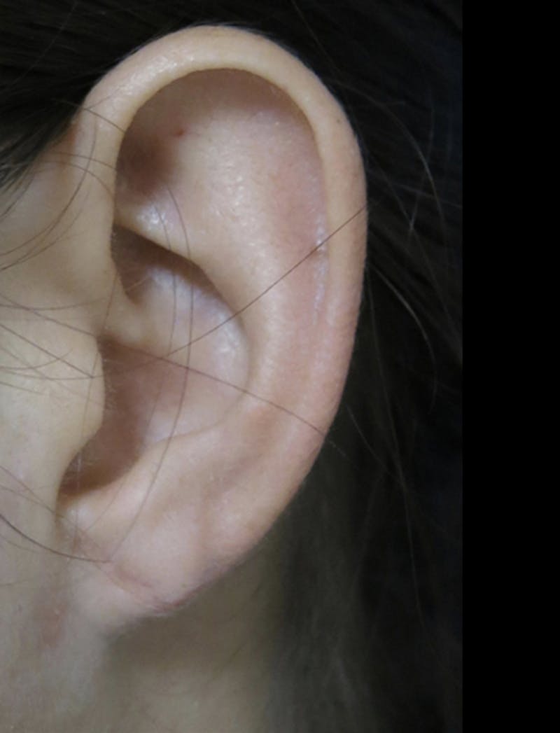 Ear Lobe Repair and Ear Reconstruction Before & After Gallery - Patient 122909098 - Image 2