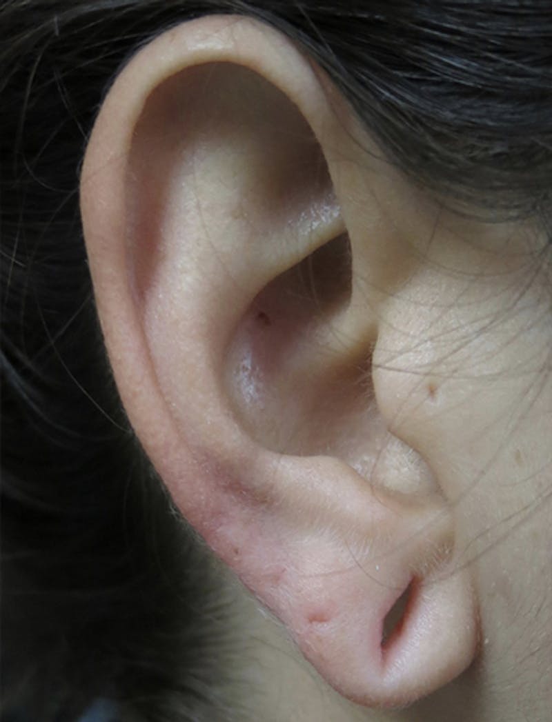 Ear Lobe Repair and Ear Reconstruction Before & After Gallery - Patient 122909098 - Image 3