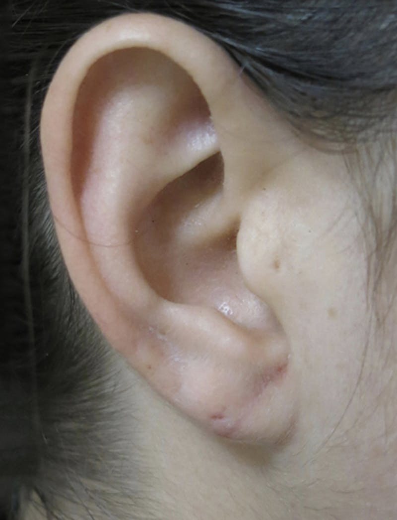 Ear Lobe Repair and Ear Reconstruction Before & After Gallery - Patient 122909098 - Image 4