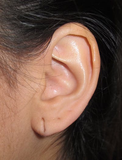 Ear Lobe Repair and Ear Reconstruction Before & After Gallery - Patient 122909104 - Image 1