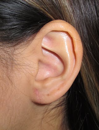 Ear Lobe Repair and Ear Reconstruction Before & After Gallery - Patient 122909104 - Image 2