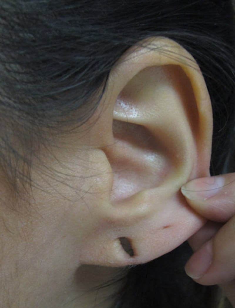 Ear Lobe Repair and Ear Reconstruction Before & After Gallery - Patient 122909104 - Image 3