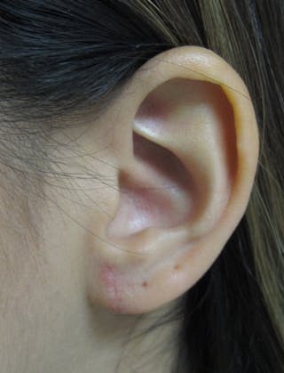Ear Lobe Repair and Ear Reconstruction Before & After Gallery - Patient 122909104 - Image 4