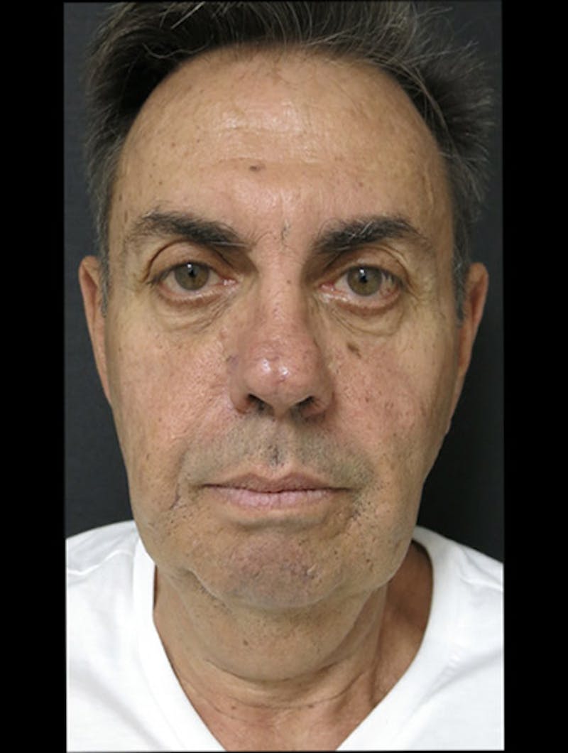 Facial Fat Grafting Before & After Gallery - Patient 122909112 - Image 3