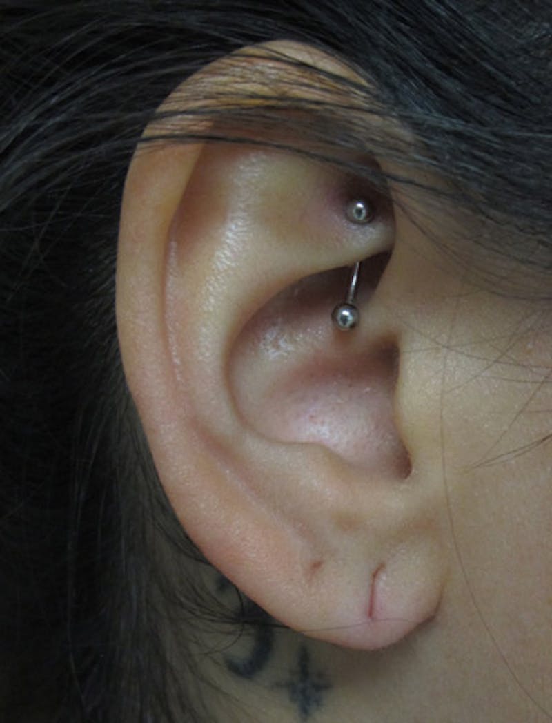 Ear Lobe Repair and Ear Reconstruction Before & After Gallery - Patient 122909104 - Image 5
