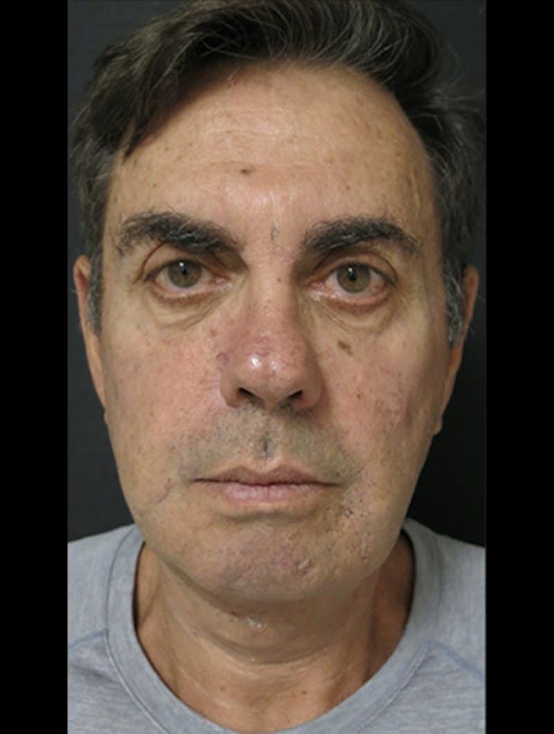 Facial Fat Grafting Before & After Gallery - Patient 122909112 - Image 4