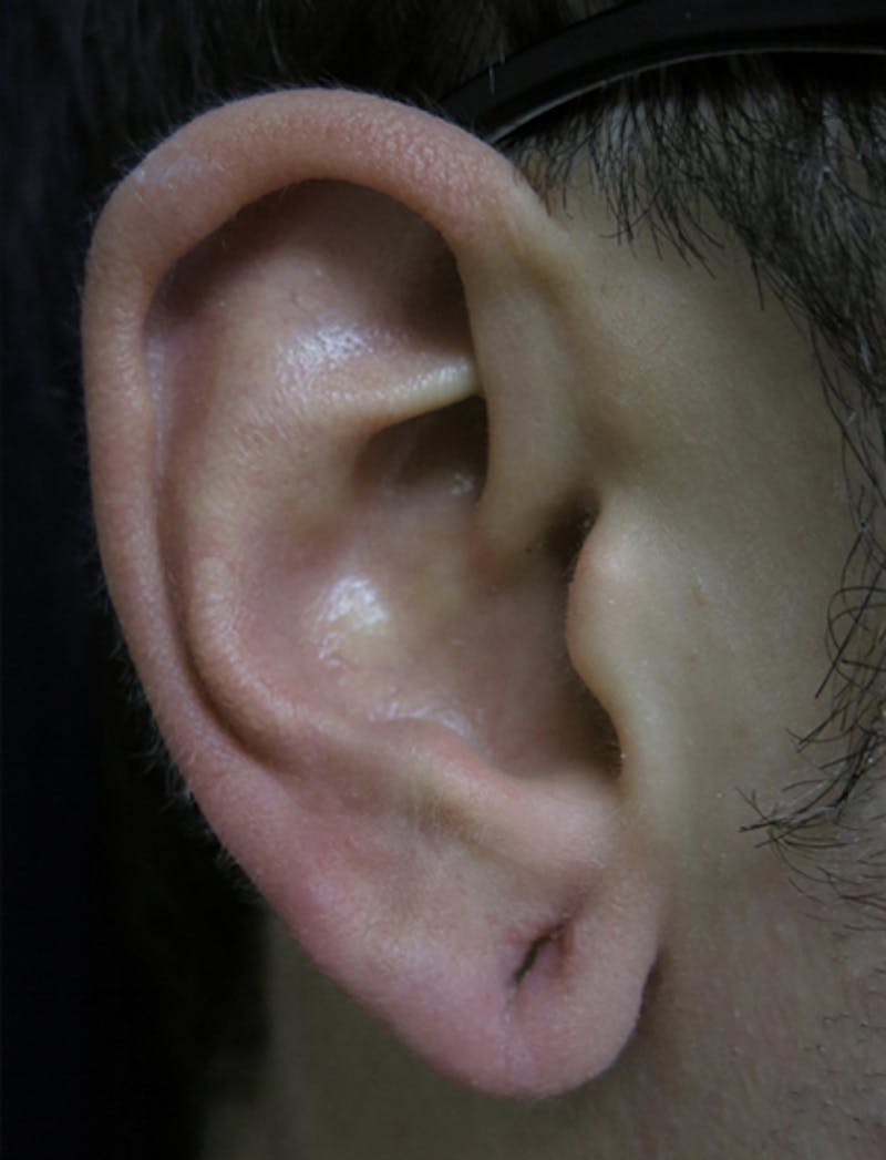 Ear Lobe Repair and Ear Reconstruction Before & After Gallery - Patient 122909108 - Image 1