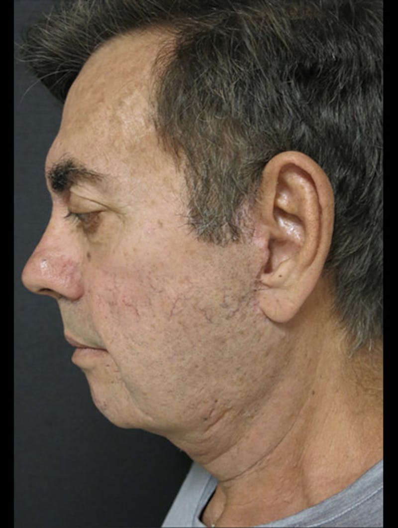 Facial Fat Grafting Before & After Gallery - Patient 122909112 - Image 6