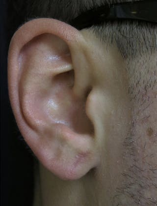 Ear Lobe Repair and Ear Reconstruction Before & After Gallery - Patient 122909108 - Image 2